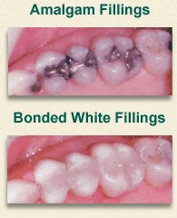 White Dental Fillings Livonia MI